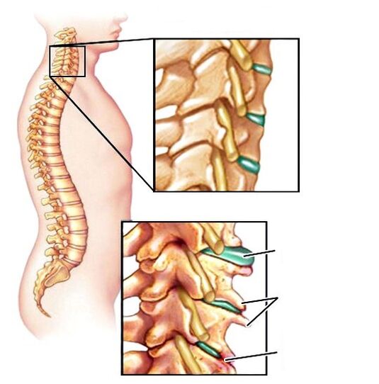 Gesunde Säule und beschädigte Osteochondrose