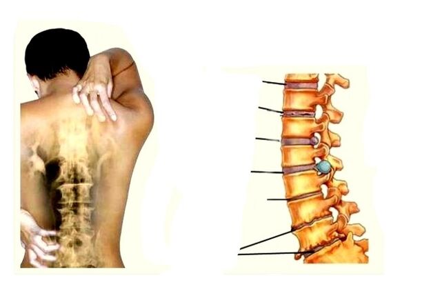 Osteochondrose -Entwicklungsphasen