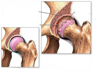 Hüftgelenk -Osteoarthritis
